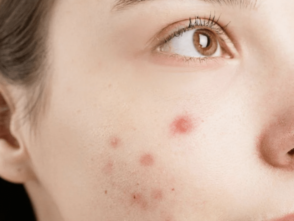 Do Eggs Cause Acne? Myths & Facts About Diet and&nbsp;Breakouts